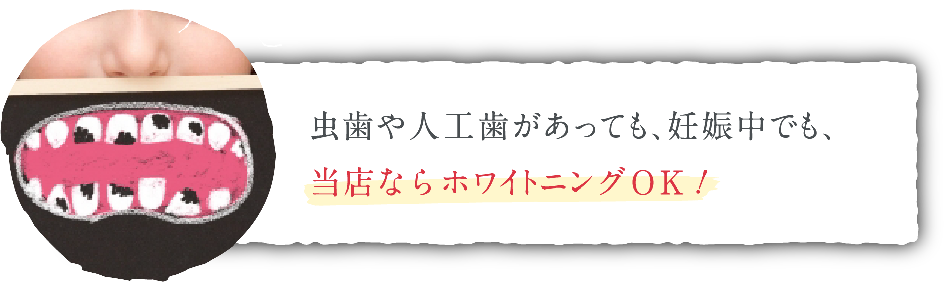 虫歯や人工歯があっても、妊娠中でも、当店ならホワイトニングOK！